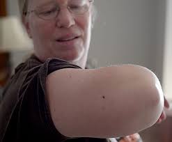 Pest practices: Battling bedbugs can be costly and confusing, and comes  with no guarantee