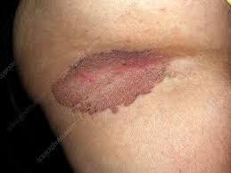 Image result for Erythrasma