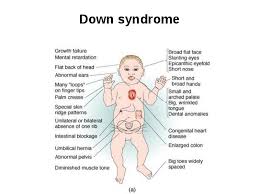 What Is Slanting Of Palpebral Fissures