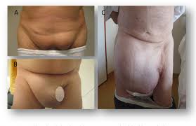 Image result for Inguinal hernia man
