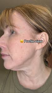 Morpheus 8 Results After 3 Treatments