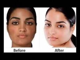 Pin On Skin Whitening Treatment For Dark Skin