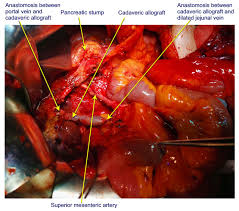 The hepatic veins and liver in circulatory failure. Superior Mesenteric And Portal Vein Reconstruction With Cadaveric Allograft During Pancreatoduodenectomy A Case Report And Literature Review In Vivo