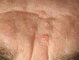 It is thought to help control blood sugar, aid in weight loss, help reduce itching. Sebaceous Hyperplasia Dermnet Nz