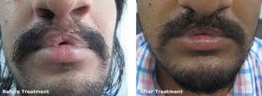 The technique of body hair transplant is basically follicular unit extraction (fue) or one by one. Beard And Moustaches Transplant At Aura Skin Institute Chandigarh India