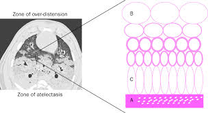 Nonetheless, commonly recommended measures include chest physiotherapy to help maintain ventilation and clearance of secretions, and encouragement of lung expansion techniques such as directed cough, deep breathing exercises, and use of an incentive spirometer. References In Ventilator Associated Lung Injury The Lancet