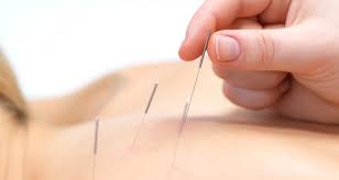 Acupuncturists rebalance the qi by inserting very fine stainless steel the acupuncturist then decides on a treatment plan, selects the acupuncture points to be. Acupuncture Preston Acupuncturist Lancashire The Acupuncture Lounge
