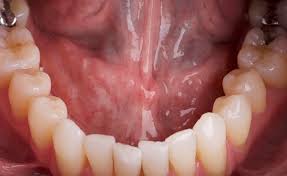 The majority of mouth cancers begin in these cells. Mouth Cancer Symptoms Causes And Treatment Stages Types Oral Cancer