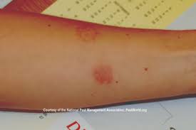 Image result for bedbugs bites