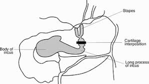 Image result for Ossicular Chain Disruption