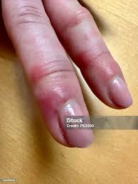 Image result for phlegmon of hand)