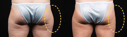 This is because this has been such. Thighs Coolsculpting Thigh Gap Before And After Photos Cost Reviews