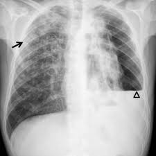To facilitate drainage of loculated hemorrhagic or fibrinous nonhemorrhagic pleural fluid collections. Spontaneous Pneumothorax A Complication Of Tuberculosis Eurorad
