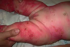 Image result for Linear Dermatitis