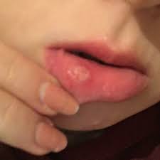 Behandle die schwellung mit warmen. Geschwollene Lippe Durch Apfel Allergie Angeschwollen Gebissen