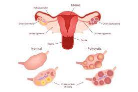 Polycystic Ovarian Disease Pcod Pcos Causes Symptoms And Treatment