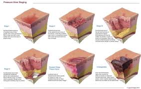 faqs for pressure ulcer staging wound care advisor