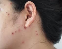 Anak kena chicken pox kering dalam masa empat hari cikjai blog. Bisakah Cacar Menular Dua Kali Meski Sudah Terkena Sebelumnya