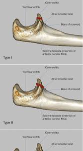 Image result for Coronoid Process Fracture