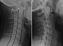 Disruption of spinolaminar line (black curved lines) at the level of. Imaging Of Spinal Trauma Radiology Key