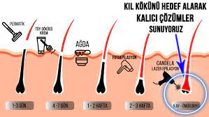 ergani candela lazer epilasyon bitme garantili sonuc veriyoruz