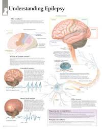 Laminated Understanding Epilepsy Educational Chart Poster