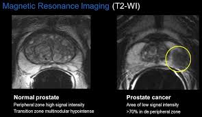 Keep in mind that … All For One A Belgian Prostate Unit At Work Healthcare In Europe Com