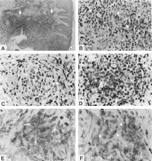 Image result for chancroid