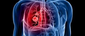 This condition is found in all ethnic groups; Alpha 1 Antitrypsin Was Bedeutet Ein Mangel