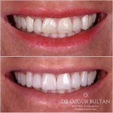 Enhancing Shape Size And Color Of The Teeth Restorations In This Smile Makeover With 10 Upper Ips E Max Veneers And Crowns Mevcut Dis Ve Restorasy Dis Renkler