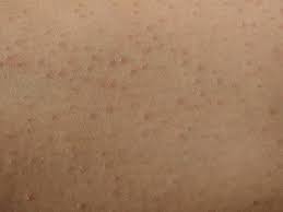 Image result for Keratosis pilaris