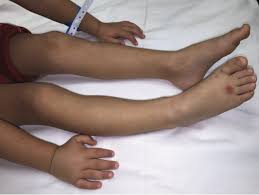 A rash of purple spots on the legs or other areas can indicate a potentially serious condition, such as allergic purpura. Henoch Schonlein Purpura A Boy With An Atypically Asymmetric Rash Consultant360