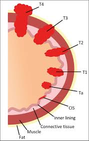 Image result for Bladder Cancer Staging