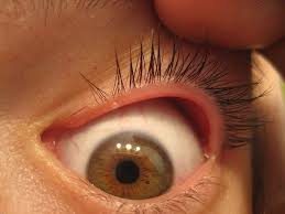 Molluscum Contagiosum Nedenleri Belirtileri Tedavisi Molluscum Contagiosum Belirtiler Ve Tedavi Doktor Tavsiyesi