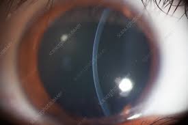 Image result for Slit Lamp