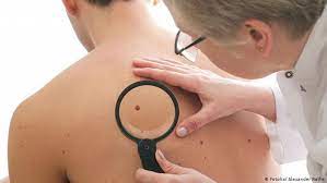 Spanish translation, synonyms, definitions and usage examples of english word 'beauty mark' When Beauty Spots Turn Dangerous Science In Depth Reporting On Science And Technology Dw 15 05 2015