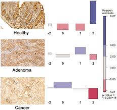 The mucus may cause cancer cells to spread more quickly and become more aggressive than typical adenocarcinomas. Plos One Genome Wide Screening Of Genes Regulated By Dna Methylation In Colon Cancer Development