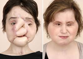 The first face transplant surgery was performed ten years ago this month. The Long Road To Cleveland Clinic S First Total Face Transplant And The Path Ahead Consult Qd