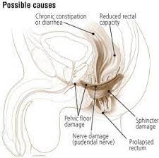 Fecal Incontinence Causes Symptoms Treatment Options Drugs Com