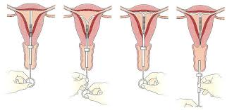 Aussi, l'effet contraceptif du stérilet hormonal se manifeste par le biais de l'hormone progestatif qui induit une atrophie endométriale. Clinique De Planning Des Naissances De Rimouski