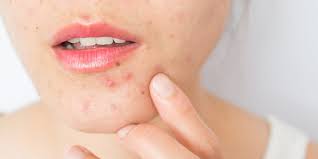 Most research shows that within a year after stopping the pill, nuvaring, or patch, 80 percent of women who want. Yes Birth Control Helps Acne Here Are The Best Options