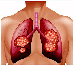 See pictures of lung cancer. The Early Symptoms And Signs Of Lung Cancer
