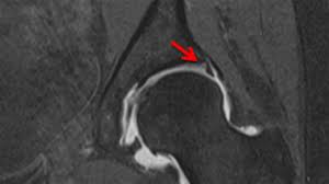 Image result for Hip Labral Tear