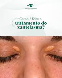 Image result for xantelasma