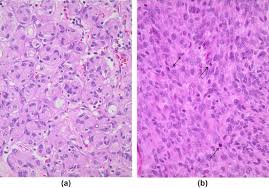 There are two general types of tumors: References In Can Ct And Mri Features Differentiate Benign From Malignant Meningiomas Clinical Radiology