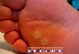 Ketuat plantar (verruca) sering muncul di tapak kaki, biasanya di kawasan yang menampung berat badan seperti tumit, dan merebak ke kulit kerana tekanan daripada aktiviti berjalan dan berdiri. Ketuat Pada Anak Anak Sebab Tanda Remedi Rumah Kanak Besar 2021
