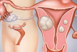 A Visual Guide To Uterine Fibroids