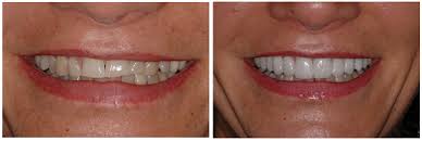 This life span takes into account how well the patient cares for their veneers proper care for composite resin veneers. Porcelain Veneers San Francisco Dental Veneers Bay Area Dr Ayoub