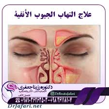 علاج التهاب الجیوب الانفیه التهاب الجيوب الأنفية المزمن أفضل علاج للجيوب الأنفية
