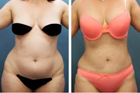 In a monsplasty, both extra skin and excess fat are surgically removed, reducing the bulge and giving the area a lift as well. What Is A Fupa Meaning Exercises Pictures And Surgery